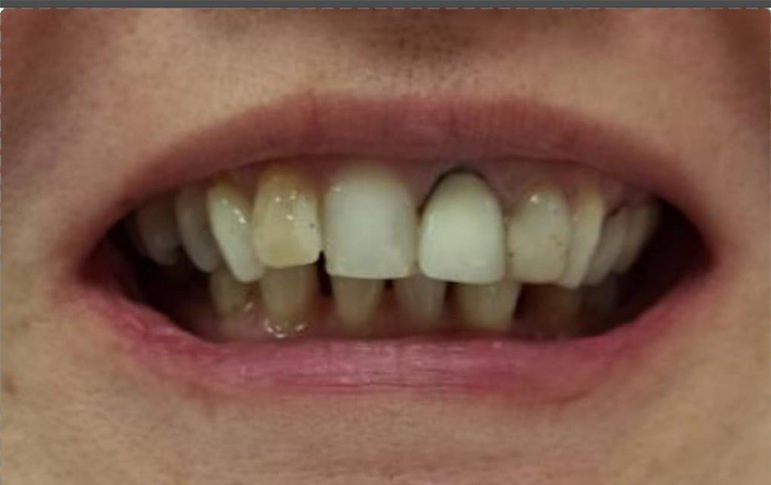 antes dente veio podi 1