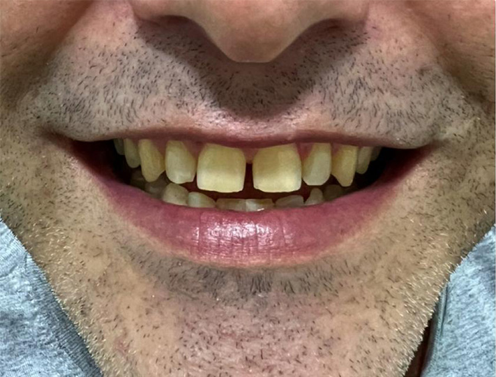 antes dente