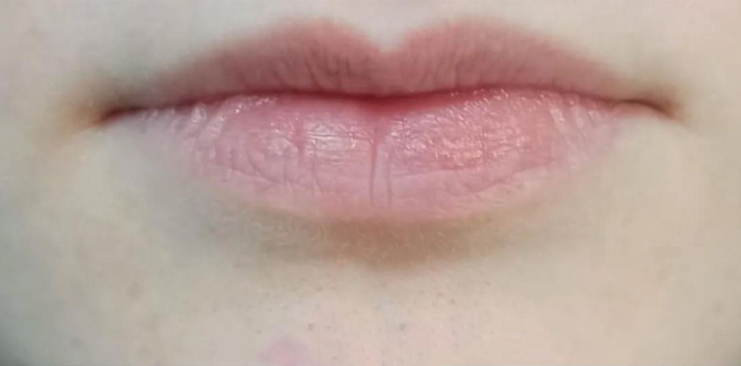 botox labial antes