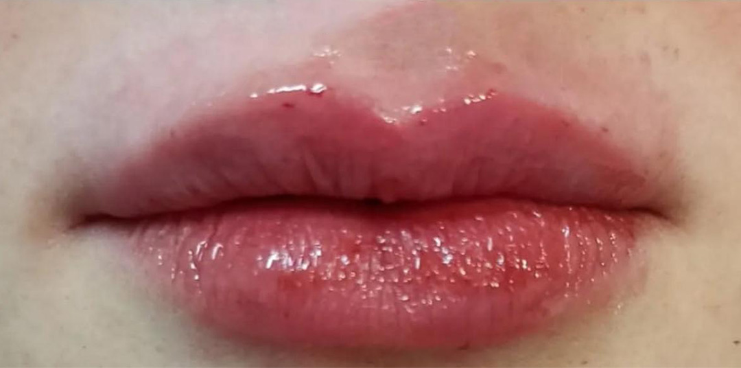 botox labial depois