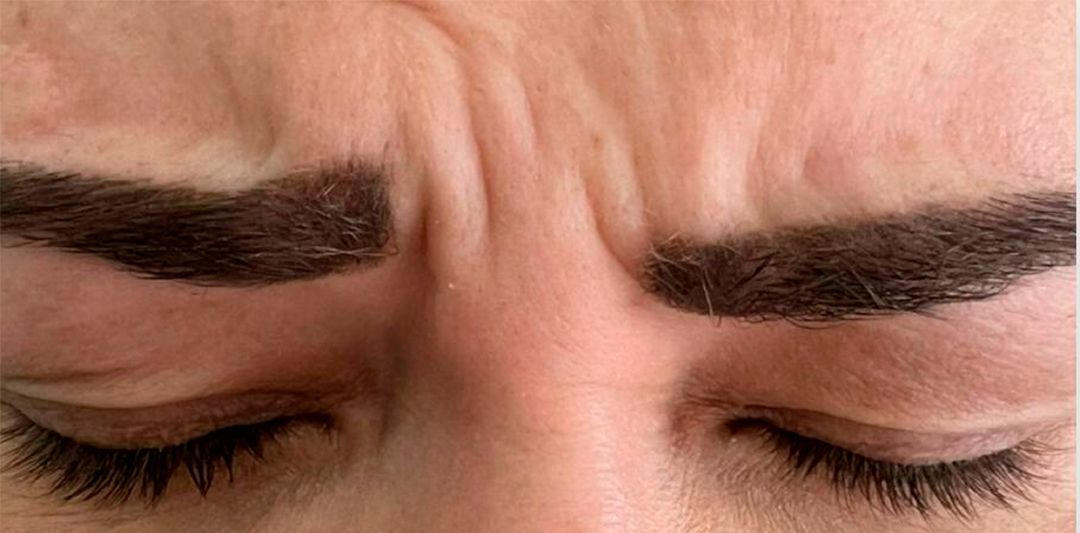 botox testa pt 1