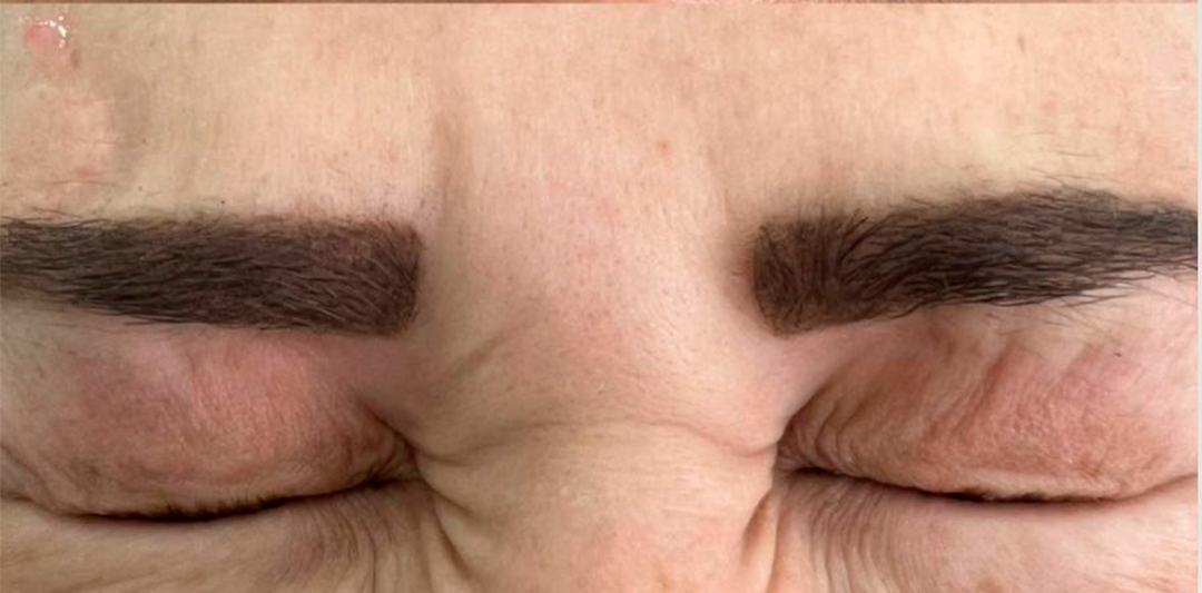 botox teste pt 2