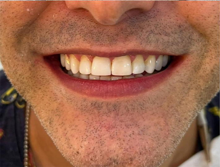 dentes depois
