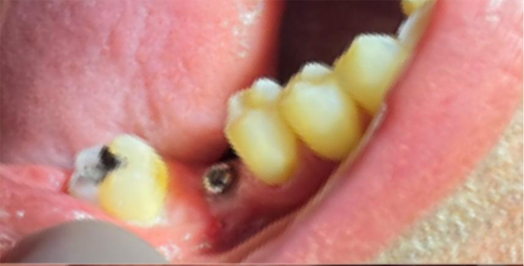 implante molar antes