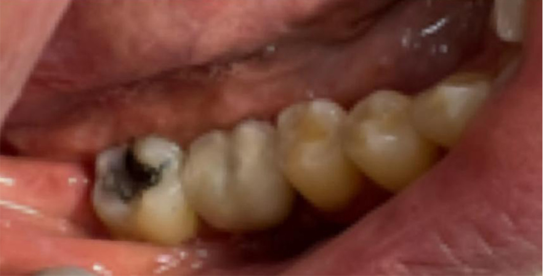 molar 2